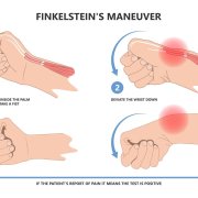 de Quervain’s Tenosynovitis
