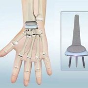 Wrist Joint Replacement