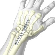 Wrist Fusion