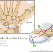 Scaphoid Fracture of the Wrist