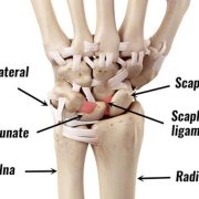 Wrist Ligament Injuries