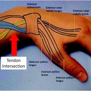 Intersection Syndrome