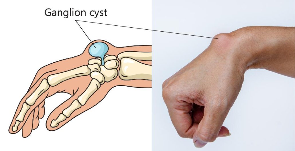 Ganglions of the Wrist