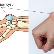 Ganglions of the Wrist