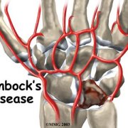 Kienbock’s Disease