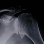 how-is-shoulder-arthritis-diagnosed.jpg How is shoulder arthritis diagnosed?
