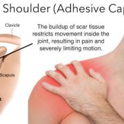 what-causes-frozen-shoulder.jpg What causes frozen shoulder?