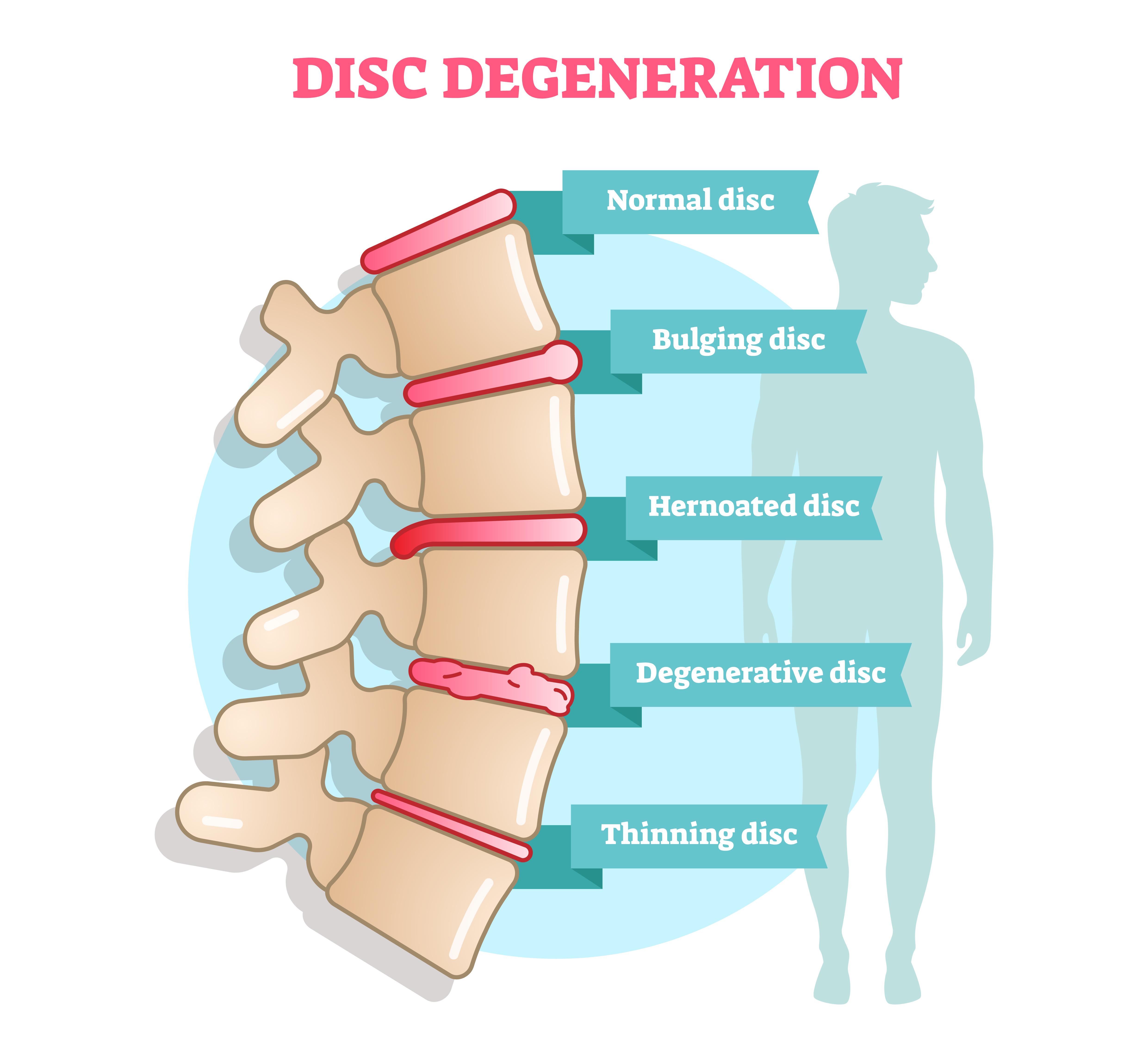 What are the treatment options for degenerative disc disease ...