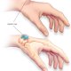 What are the symptoms of ganglion cysts?
